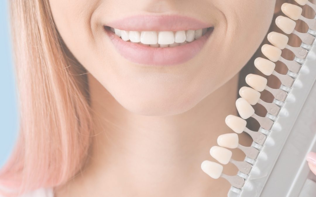 ¿Qué son las carillas dentales y cuándo se utilizan?