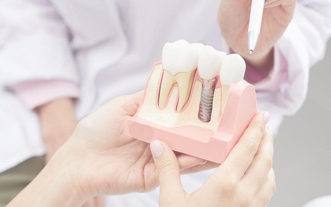 ¿Cómo es la recuperación tras un implante dental?